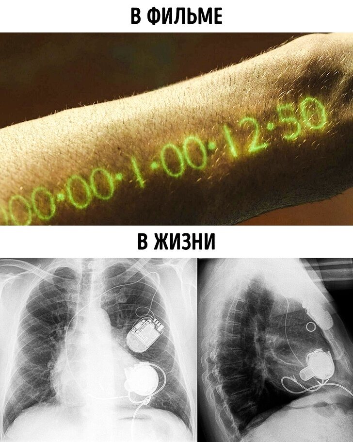 С 2015 года врачи спасают людей с тяжелыми заболеваниями сердца, заменяя данный орган на VAD-устройства. Что-то подобное зрители могли видеть в фильме «Адреналин-2: Высокое напряжение» (2009), когда главному герою вместо сердца установили электронный аналог. Но в реальной жизни все куда интереснее, и особого внимания заслуживает одна из последних разработок — VAD с возможностью беспроводной зарядки.