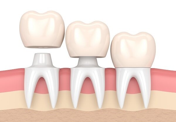 Зуб под коронкой