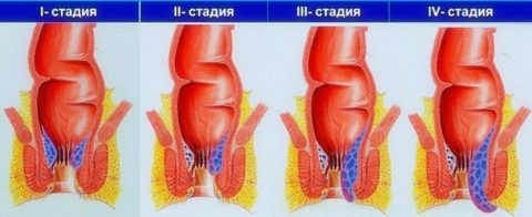 Стадии геморроя