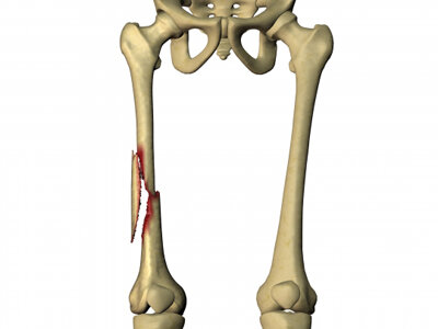  Перелом тела бедренной кости