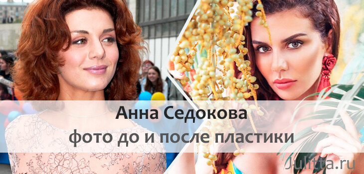 Анна седакова после последней пластики 2025 фото Певица Анна Седокова: фото до и после пластики + 15 новинок Самая-самая Дзен