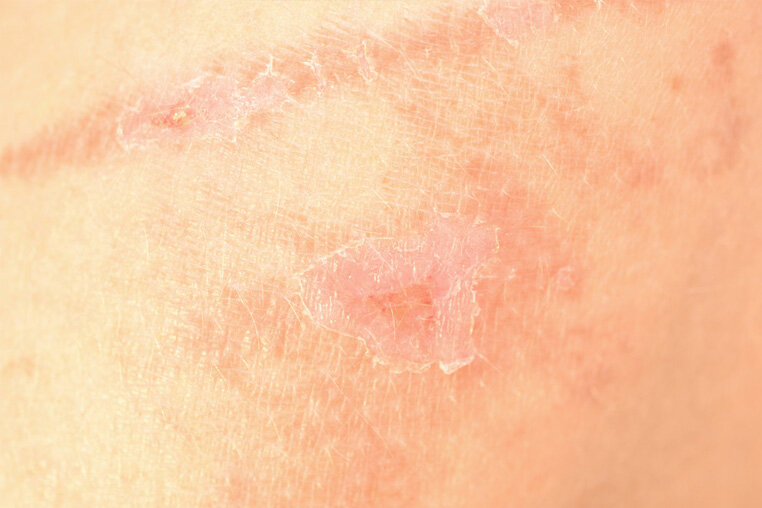 Кератоз - опасная болезнь, требующая немедленного лечения.