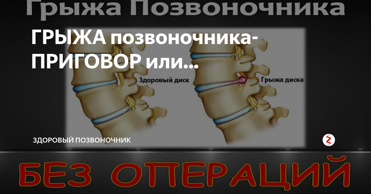 Инвалидность после операции на позвоночнике грыжа. Грыжа позвонков инвалидность. Небольшая грыжа на позвоночнике. Самолечение грыжи позвоночника. Здоровый рух грыжа позвоночника.