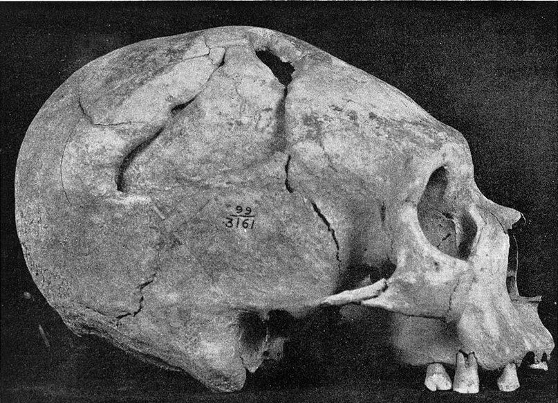 Обнаруженный в Перу череп со следами трепанации