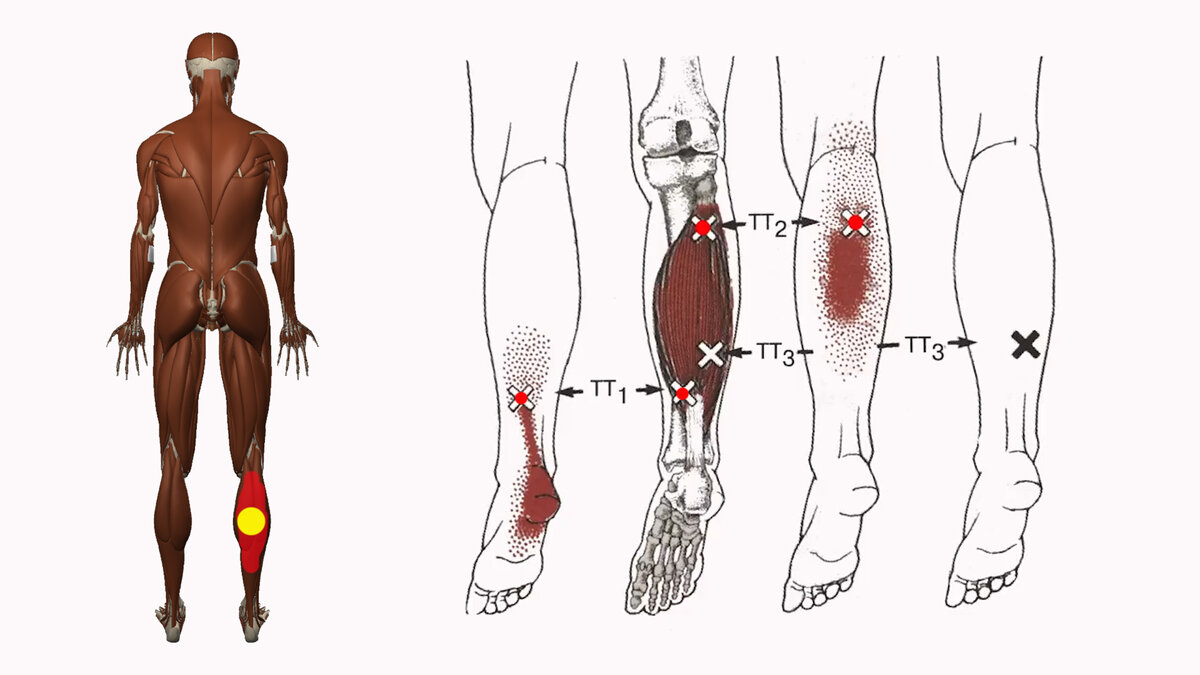 Триггерные точки большеберцовой мышцы голени. Миофасциальные боли триггерные точки. Триггерные точки голени массаж. Триггерные точки камбаловидной мышцы.
