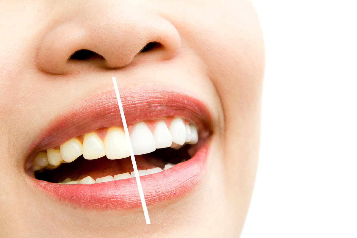 <a href="https://ru.freepik.com/free-photo/woman-in-a-whitening-treatment_969612.htm#query=%D0%B1%D0%B5%D0%BB%D1%8B%D0%B5%20%D0%B7%D1%83%D0%B1%D1%8B&position=5&from_view=search&track=ais">Изображение от jannoon028</a> на Freepik