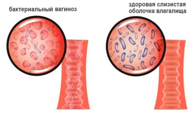 Бактериальный вагиноз (дисбактериоз влагалища)