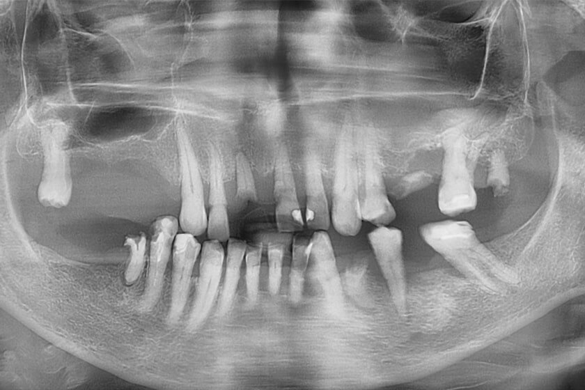 Зачем делать панорамный снимок зубов | Цифровая стоматология Денталь в ...