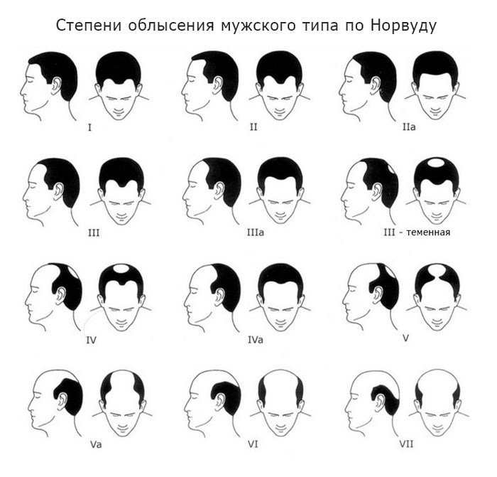 Стадии облысения мужского типа. Источник изображения: volosgood.ru