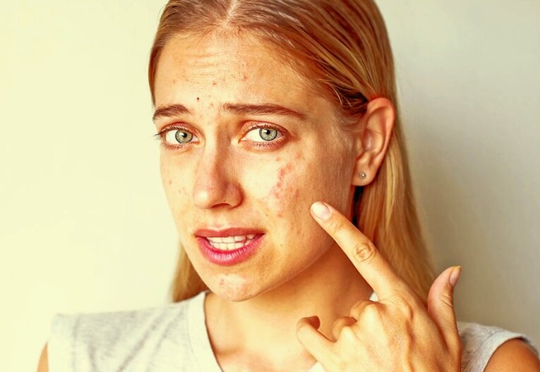                                    Причины появления прыщей у взрослых людей