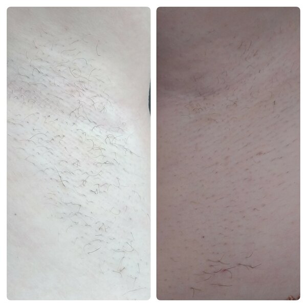 Фото подмышечной впадины до и после процедуры