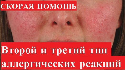 Внимание!Вся информация в видео только для ознакомительных целей!При возникновении каких либо симптомов вызывается скорая медицинская помощь! 