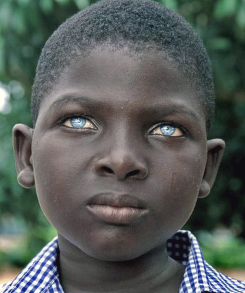 Синдром Ваандербурга