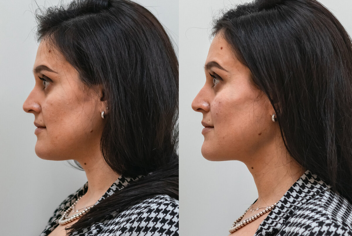 Фото до и сразу после процедуры | все фото предоставлены клиникой.