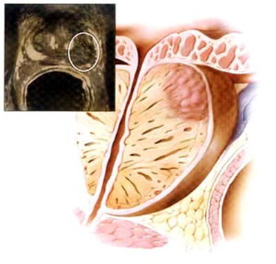Рак простаты – является самым распространённым злокачественным новообразованием у мужчин