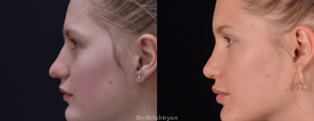 Фото до и после ринопластики носа. Фото с сайта Д.Р. Гришкяна. Имеются противопоказания, требуется консультация специалиста