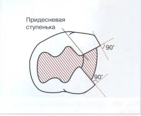 Придесневая стенка в полостях v класса препарируется под углом