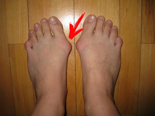 косточка на большом пальце, лечение косточки на пальце, здоровье, медицина, шишка на пальце ноги