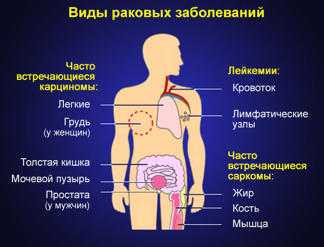 Раковые заболевания