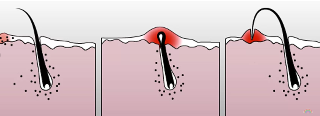 Выдернул волос с луковицей. Вросший волос последствия. Глубокие врастания волос.