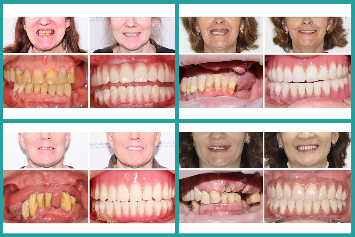 Так выглядят пациенты клиники Smile-at-Once до и после имплантации зубов