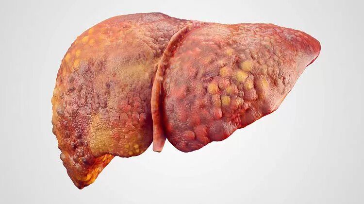 Цирроз печени — это процесс перерождения нормальной печеночной ткани в соединительную. Фото: Flickr 