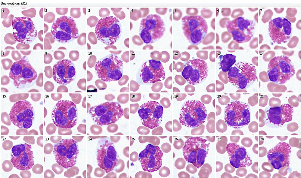 Эозинофилы дерматит. Эозинофилы гистология. Кровь гистология эозинофилы. Лейкоформула микроскопия.