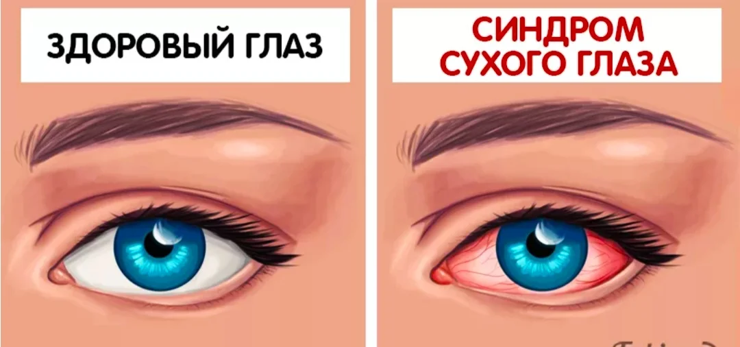 ССГ (синдром сухого глаза. Синдром сухого глаза причины. Глазки сухо