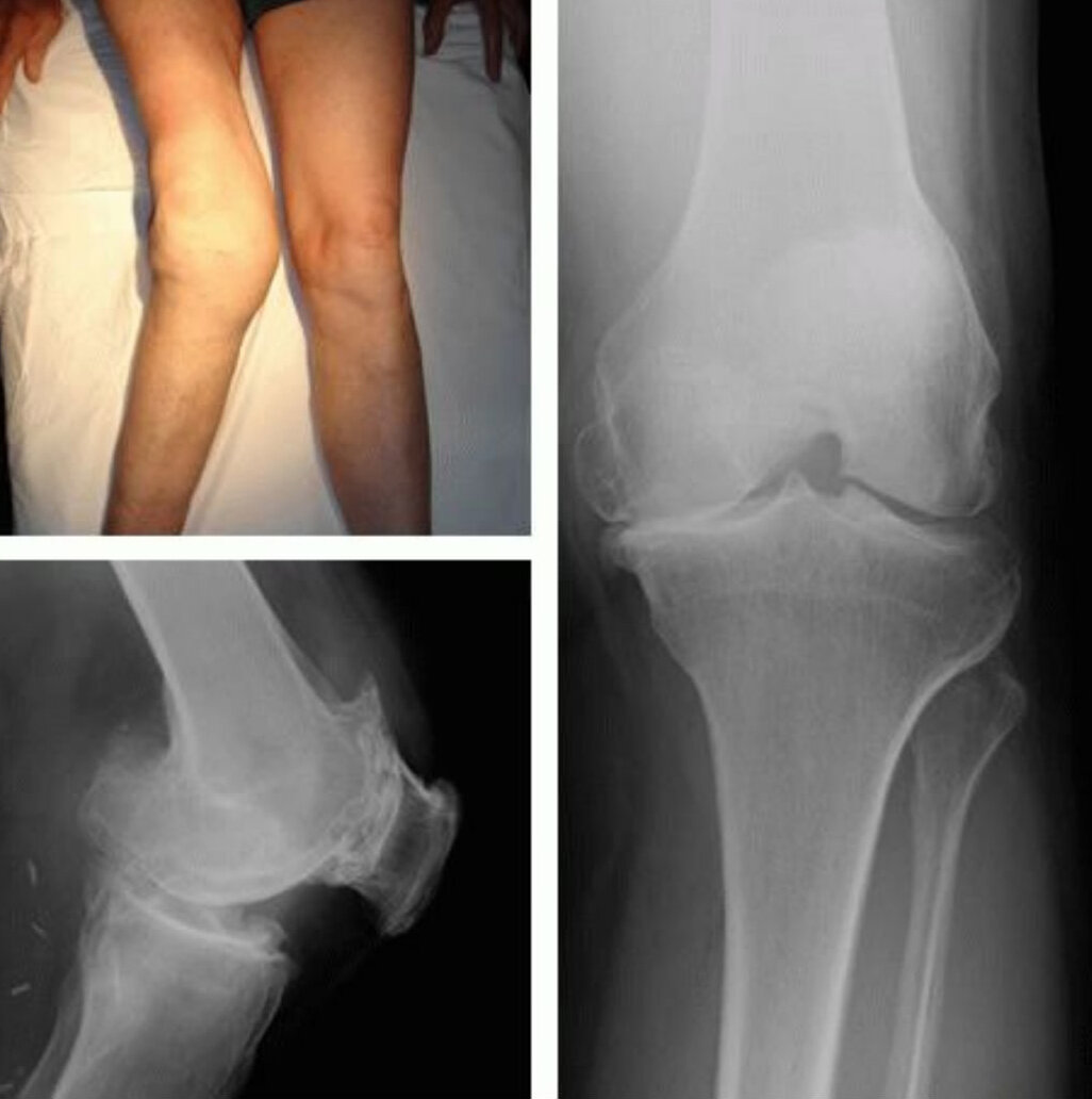 Деформирующий остеоартроз коленного сустава рентген