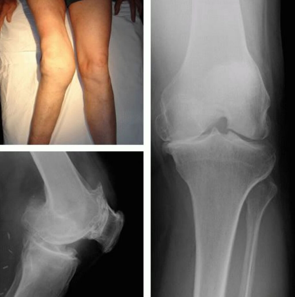 Деформирующий остеоартроз суставов. Деформирующий остеоартроз коленного сустава рентген. Деформирующий гонартроз коленного сустава. Гонартроз 2 степени рентген.