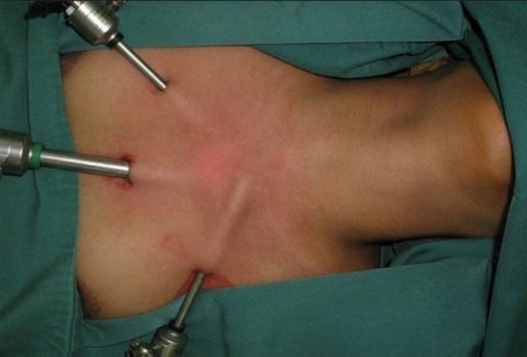  Эндоскопическая методика проведения оперативных вмешательств на щитовидной железе