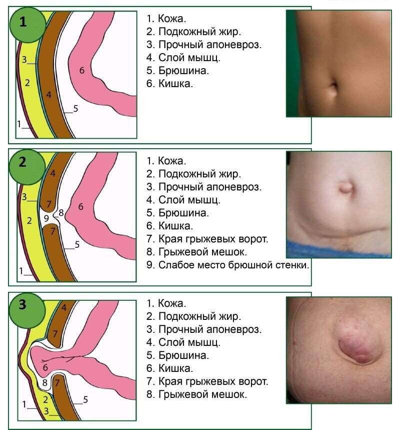как выглядит пупочная грыжа фото | Дзен