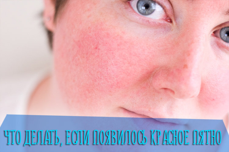 Шелушатся пятна на лице: чем лечить шелушащиеся сухие пятнышки