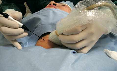 Лазерное удаление злокачественных и доброкачественных узлов Щитовидной железы эффективнее операции!