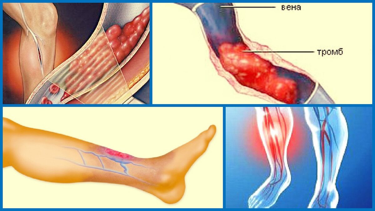 Тромп у человека. Облитерирующий тромбофлебит. Септический тромбофлебит.