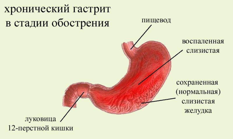 Как быстро снять обострение гастрита