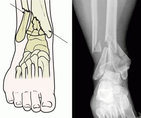  Рентгенологический снимок полученной травмы