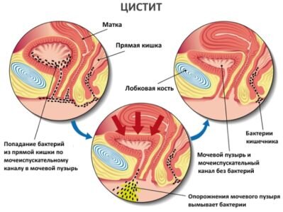   Посткоитальный цистит – весьма неприятная форма воспаления мочевого пузыря, которая проявляется в скором времени после совершения полового акта.-2