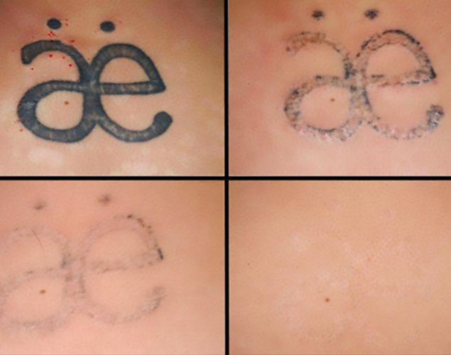 Сведение тату, до и после. Следов практически не остаётся