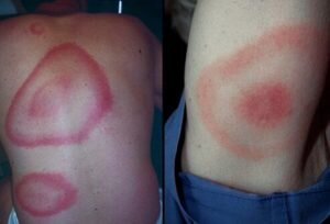 Красные пятна на теле: причины появления пятен на коже, методы лечения, диагностики и профилактики