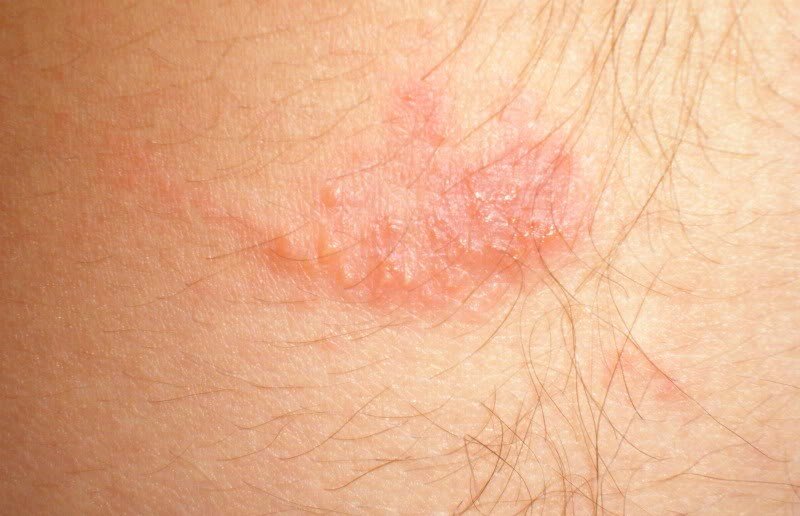Острая крапивница – аллергическая реакция на коже