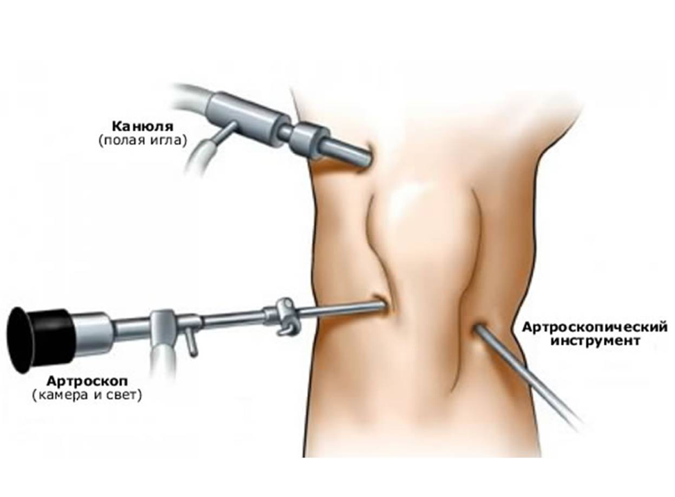 Лазерная деструкция Кисты Бейкера