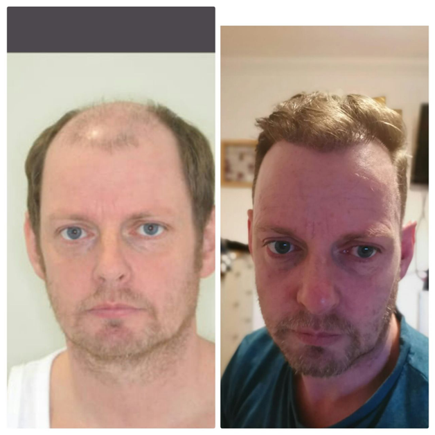 Трансплантация волос до и после. Пересадка волос до и после. До и после пересадки волос мужчинам.