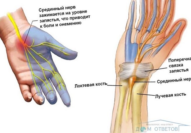 Что такое поражение лучевого нерва?