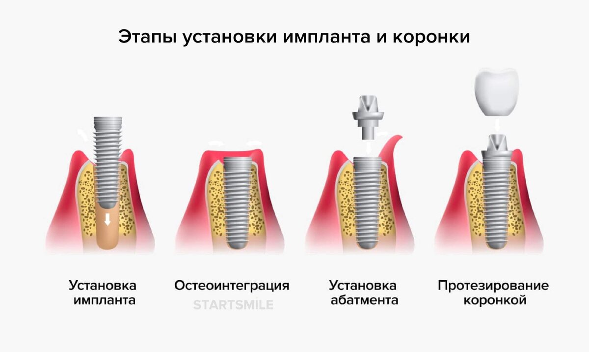 Устройство зубного импланта схема Плюсы и минусы методов имплантации зубов