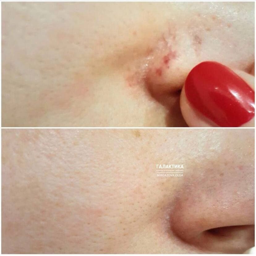 Работа Ольги Дагиевны Миргазовой - врача-косметолога Клиники "Галактика"