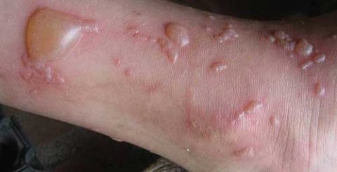  Пузыри, заполненные транссудатом