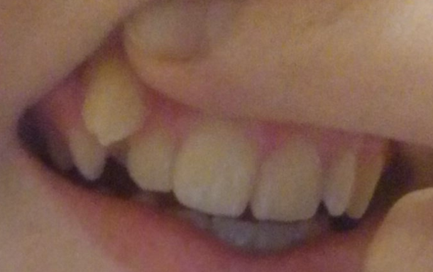 фото взято с интернета, копия зуба дочери на данный момент.