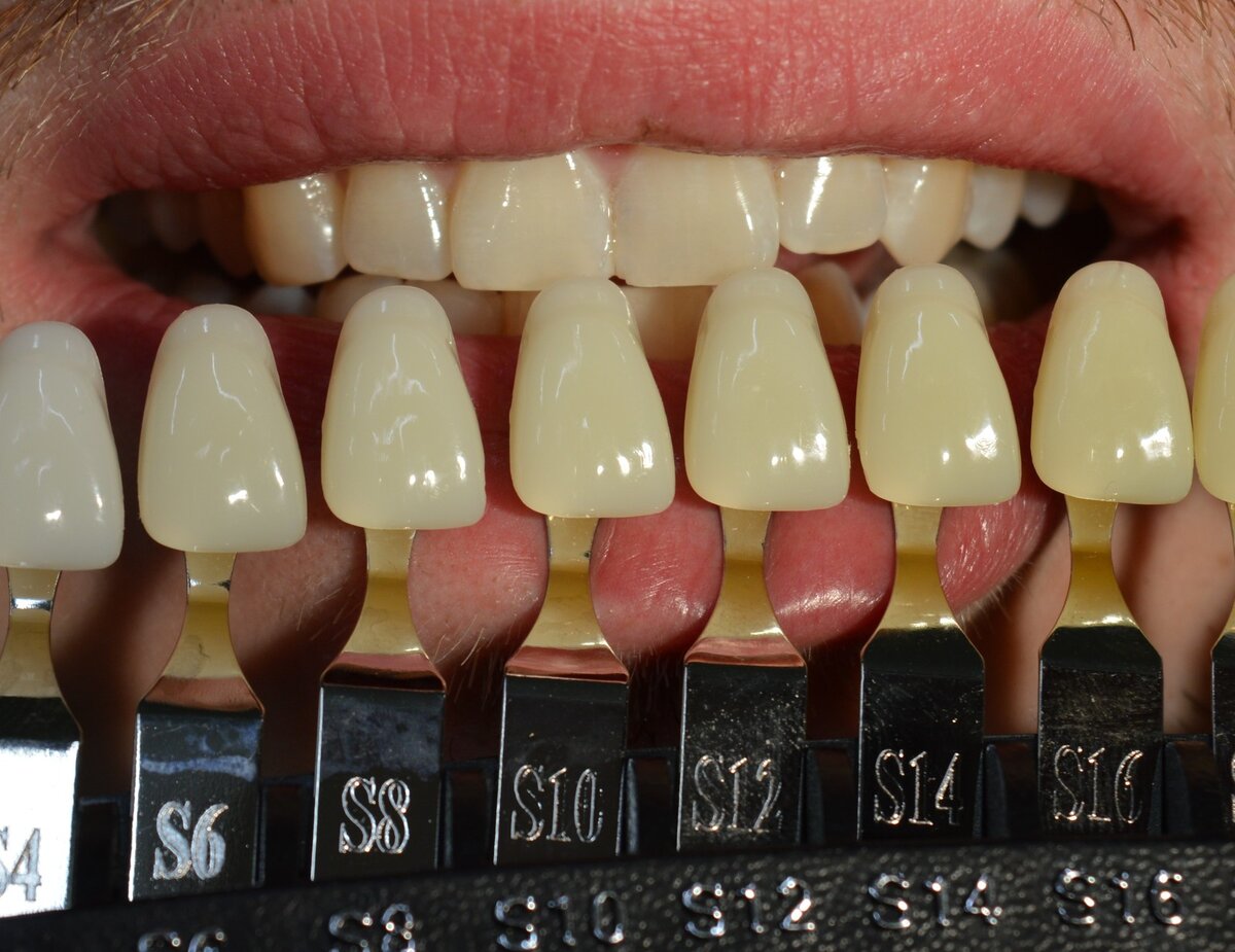 Названы результаты по 5 способам отбеливания зубов. На сколько тонов и  сколько стоит отбелить зубы | Без юриста | Дзен