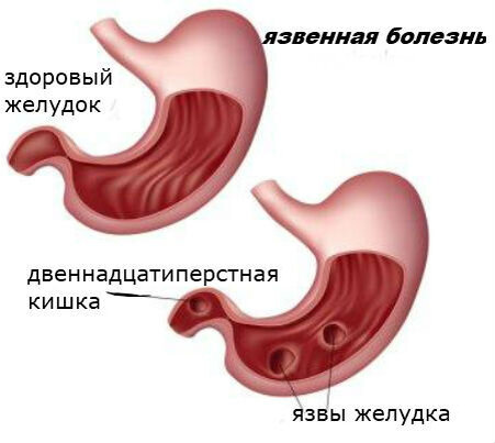 Язвенная болезнь желудка и 12-перстной кишки